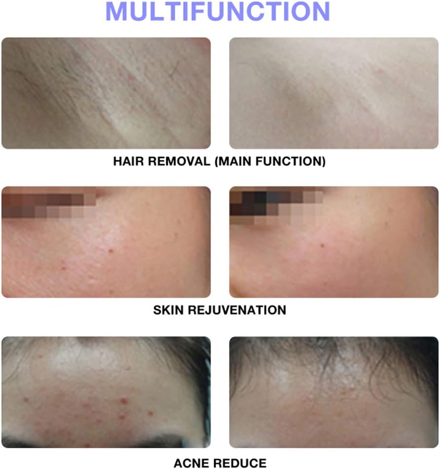 Intense Pulsed Light Hair Removal ©