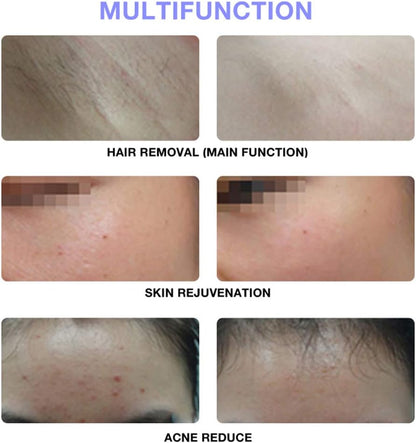 Intense Pulsed Light Hair Removal ©